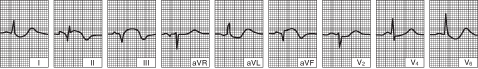 Inferior (diaphragmatic) left ventricular infarction (after the first 24 hours)