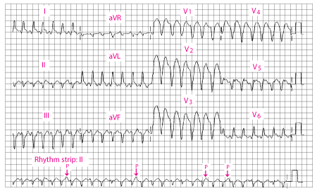 Broad QRS ventricular tachycardia