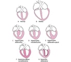 Overview of Cardiomyopathies