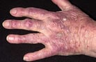 Skin Manifestations of Internal Disease
