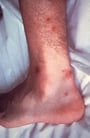 Acute Infectious Arthritis