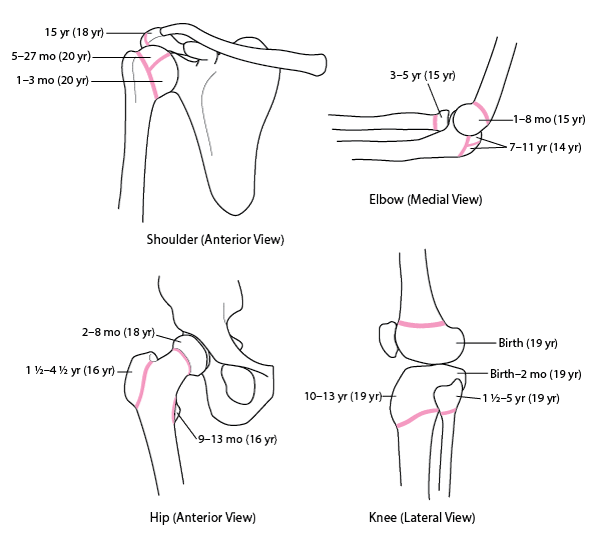 Pediatric Physeal (Growth Plate) Fractures - Injuries; Poiso