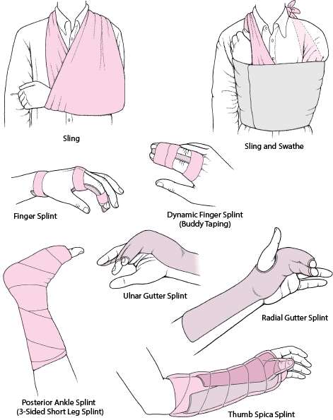 Joint immobilization as acute treatment: Some commonly used techniques
