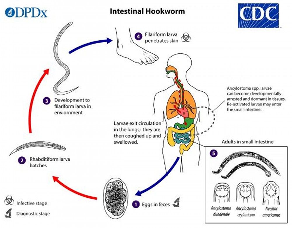 Hookworm Infection - Infectious Diseases - MSD Manual Professional Edition