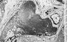Fibrillary and Immunotactoid Glomerulopathies