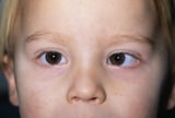 Ocular deviations in strabismus