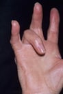 Digital Flexor Tendinitis and Tenosynovitis (Trigger Finger)