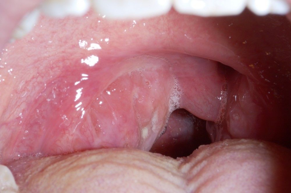 Tonsillitis from oral sex