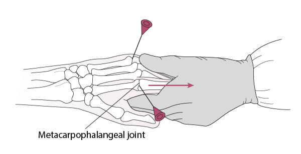 Arthrocentesis of the Metacarpophalangeal Joint