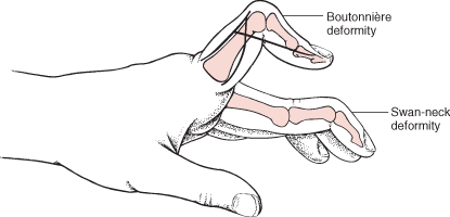 Boutonnière and swan-neck deformities