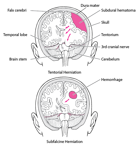 Brain herniation