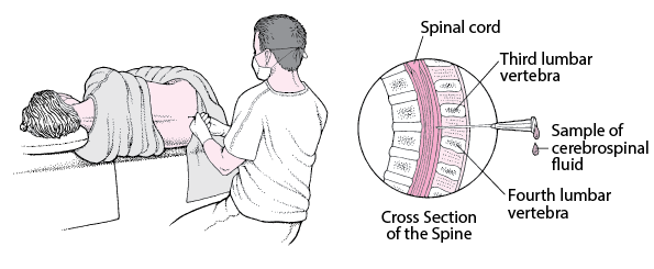 Lumbar Puncture (Spinal Tap) - Neurologic Disorders - MSD Manual  Professional Edition