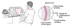 Lumbar Puncture (Spinal Tap)