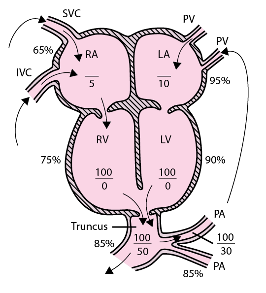Truncus arteriosus