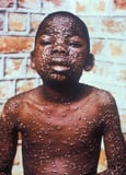 Smallpox