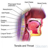 Tonsillopharyngitis