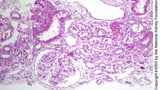 Acute Tubular Necrosis (ATN)