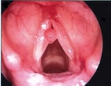 Vocal Cord Polyps, Nodules, and Granulomas
