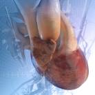 Thromboangéite oblitérante