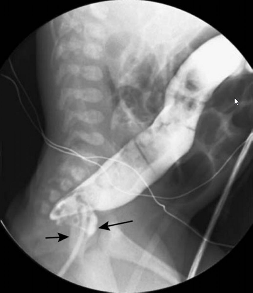 Doença de Hirschsprung - Pediatria - Manuais MSD edição para profissionais, image size:863x1000