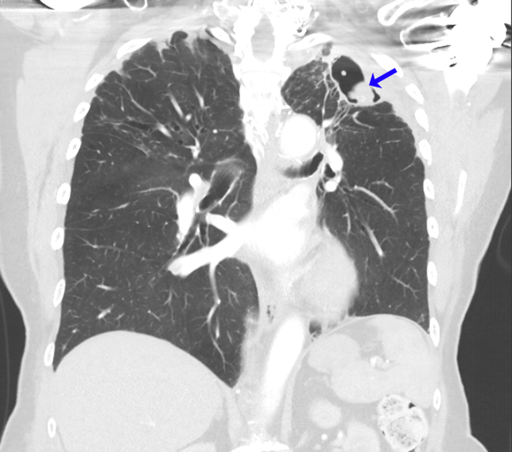 Aspergillosi - Malattie infettive - Manuali MSD Edizione Professionisti