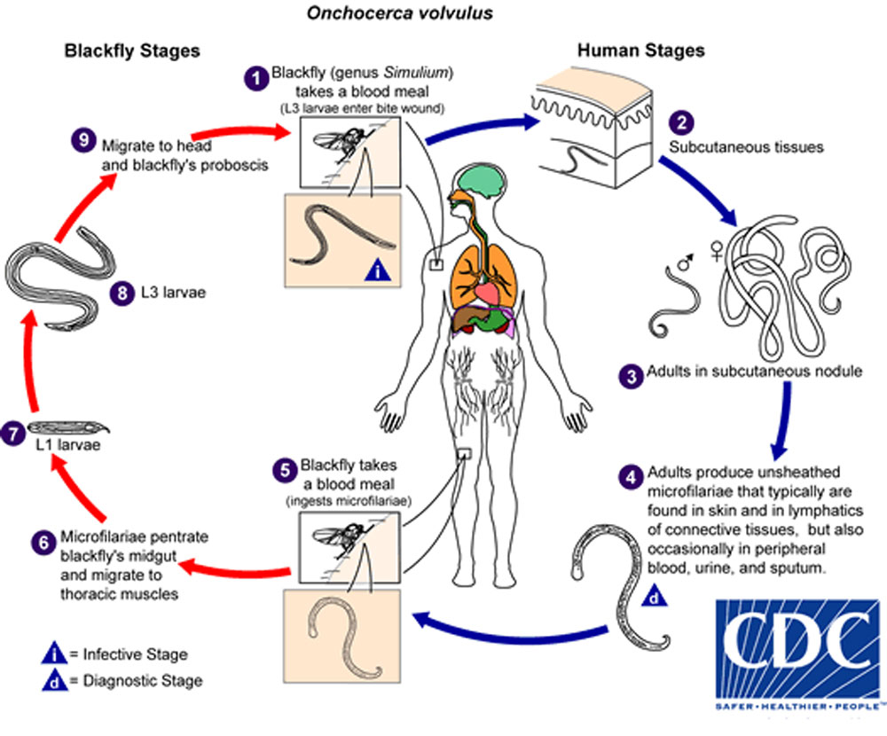 Oncocercosis (Ceguera de los ríos) - Enfermedades infecciosas - Manual MSD  versión para profesionales, image size:1000x830