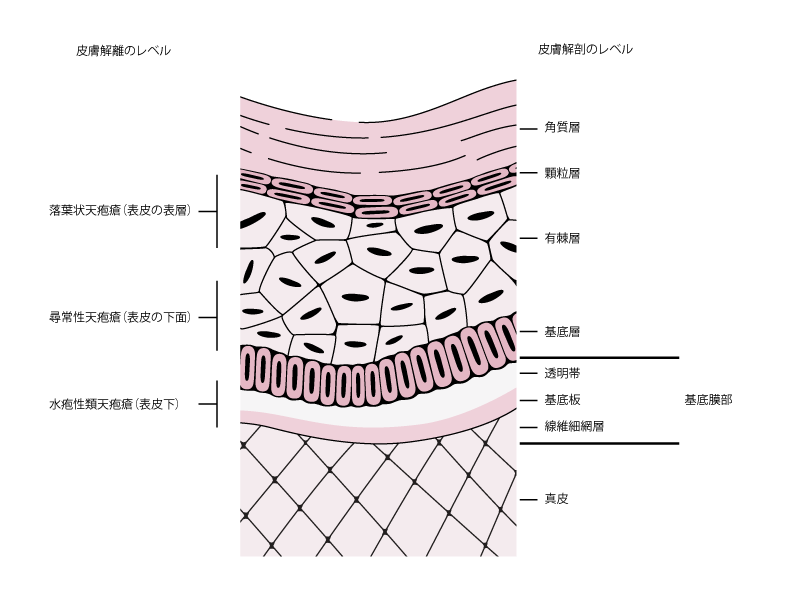 落葉状天疱瘡 - 14. 皮膚疾患 - MSDマニュアル プロフェッショナル版