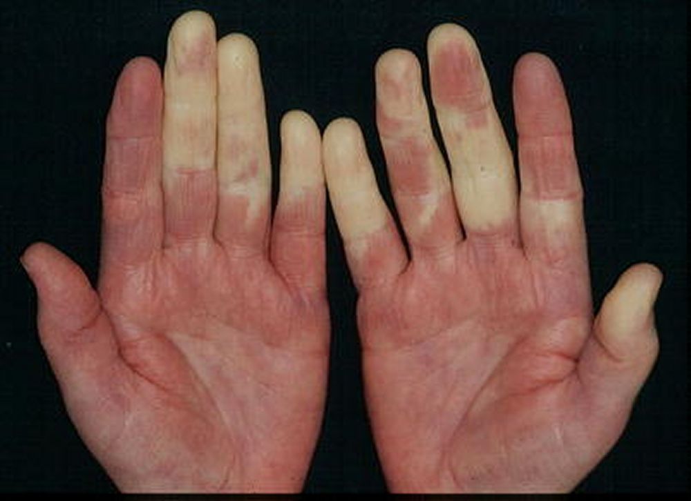 Quick Facts: Raynaud Syndrome - MSD Manual Consumer Version