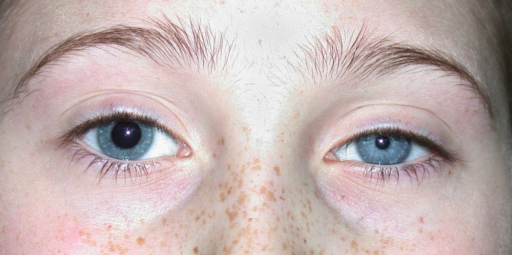 Pupils, Unequal - Eye Disorders - MSD Manual Consumer Version