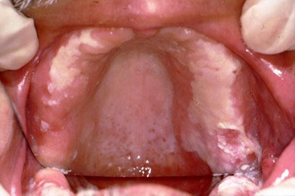 Water blister under tongue