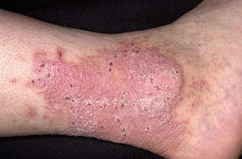 papilloma vírus és dermatitis