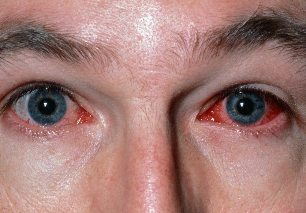 Quick Facts: Infectious Conjunctivitis - MSD Manual Consumer Version