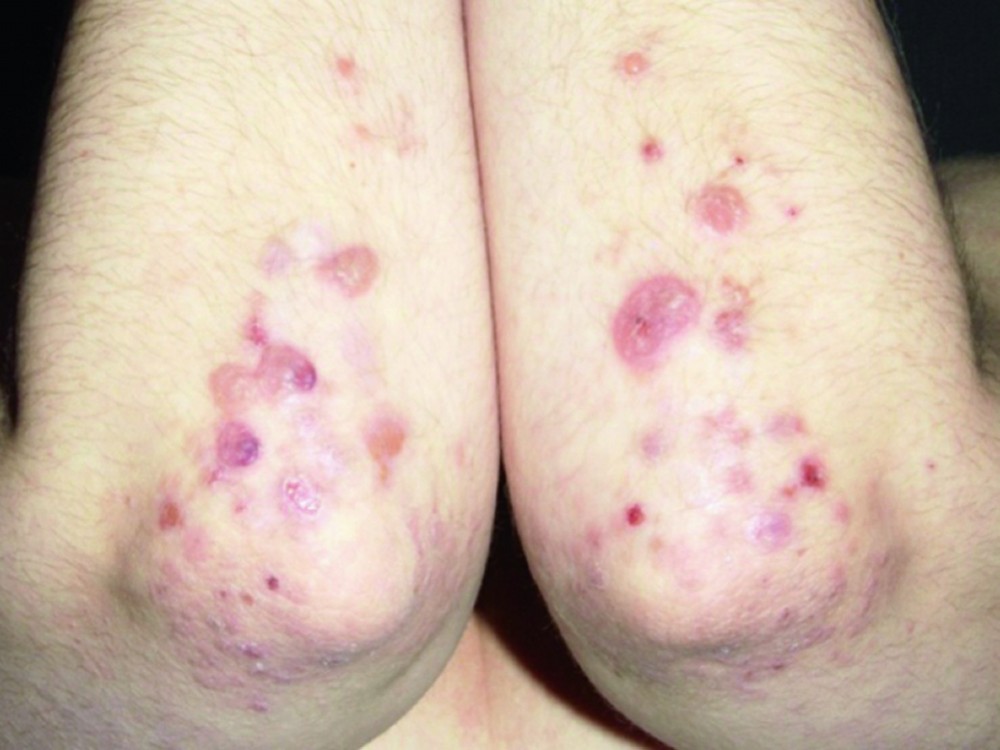 herpetiform dermatitis duhring papillomavírus 1. stádium és terhesség