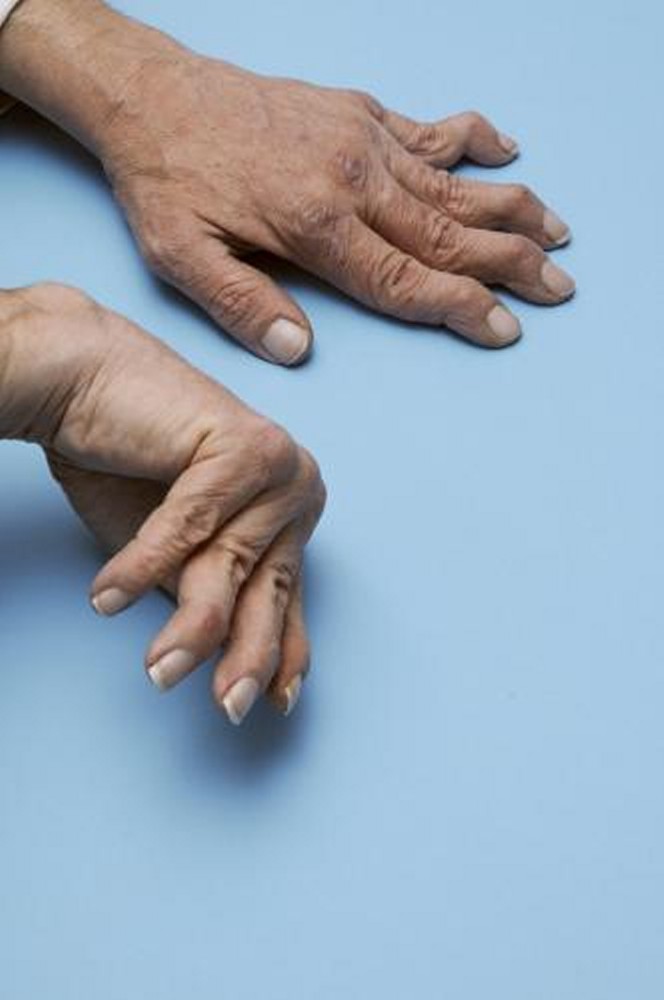 reumatoid artritisz labor A hamis osteomyelitis komplikált ízületének kezelése