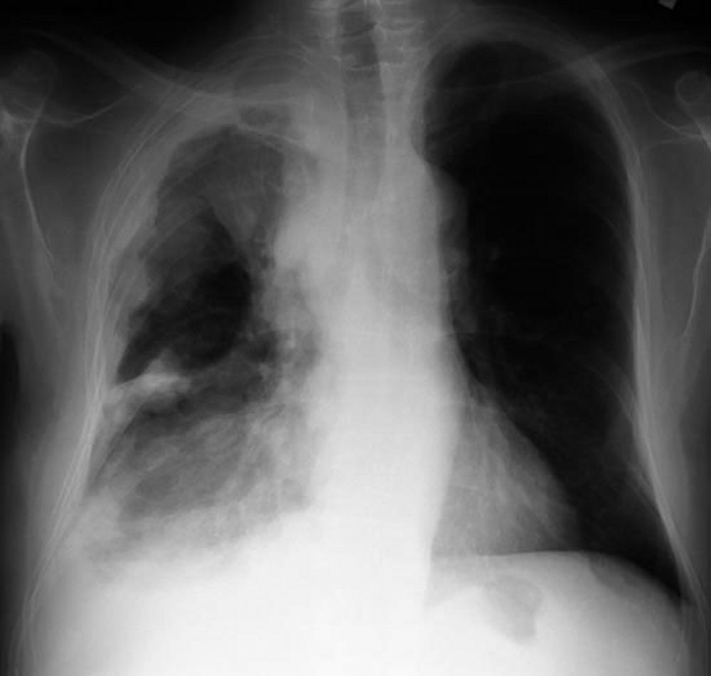 pd l1 in mesothelioma