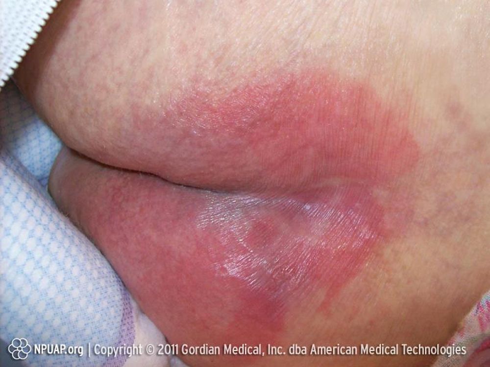 Ulcer decubitus Decubitus ulcers