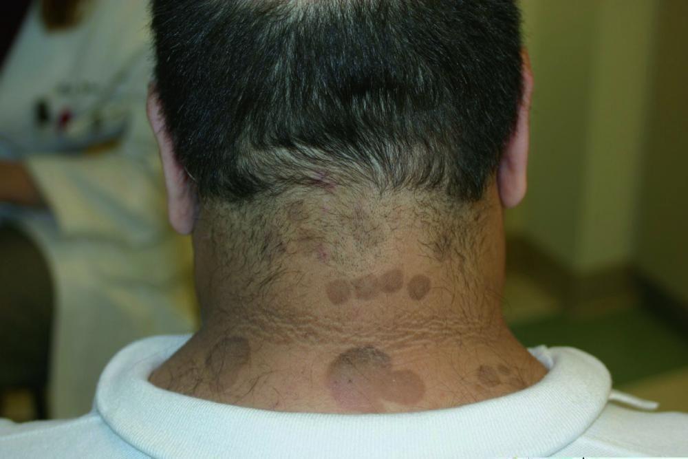 गर्दन पर टिनिया वर्सिकलर के कत्थई चकत्ते