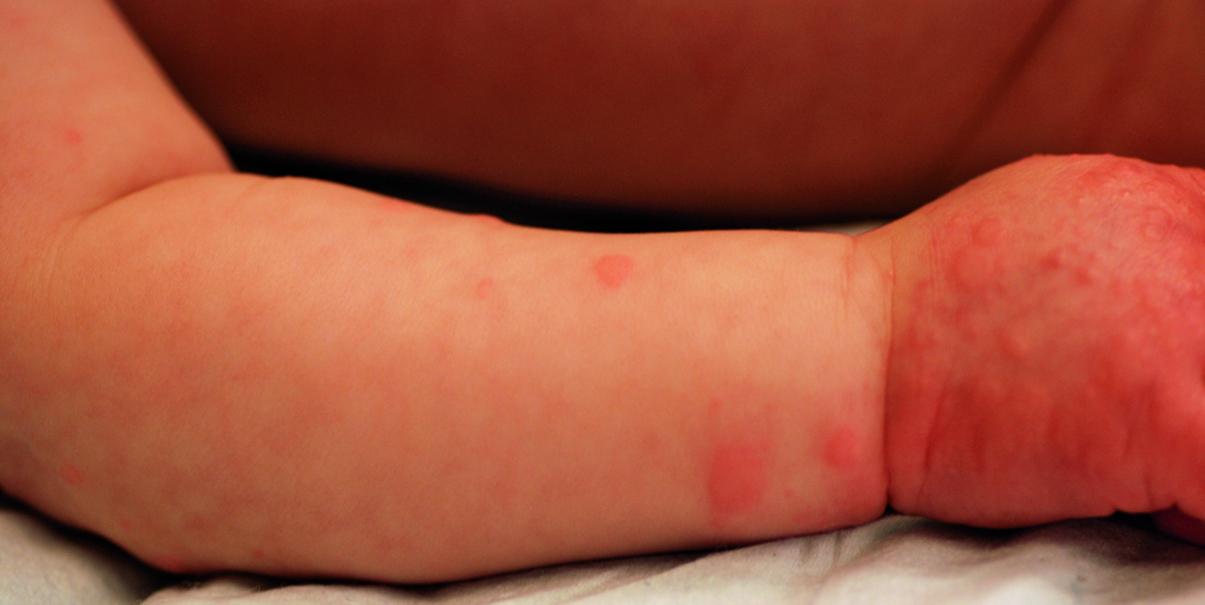 蕁麻疹と水疱性類天疱瘡
