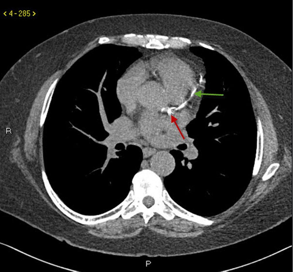 Chụp CT không thuốc cản quang cho thấy vôi hóa động mạch vành
