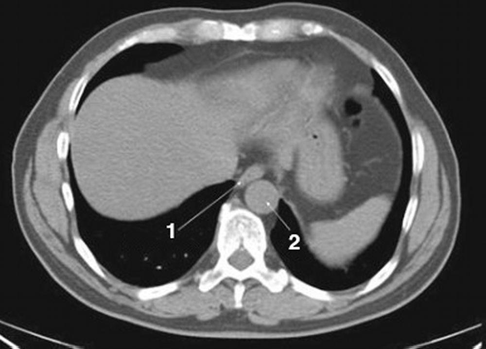 Phim chụp CT vùng bụng và xương chậu không thuốc cản quang cho thấy giải phẫu bình thường (lát cắt 1)