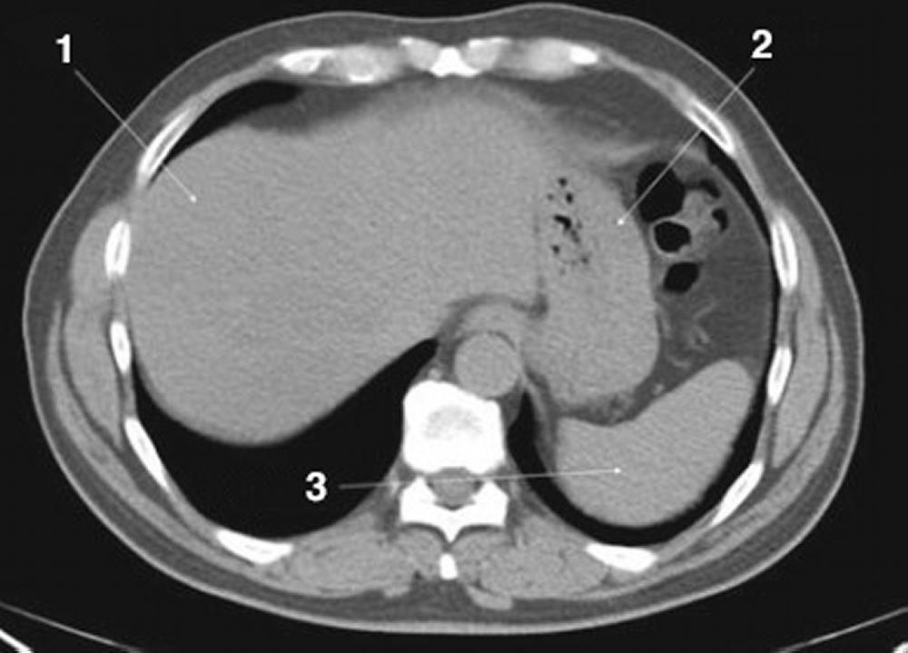 Phim chụp CT vùng bụng và xương chậu không thuốc cản quang cho thấy giải phẫu bình thường (lát cắt 3)
