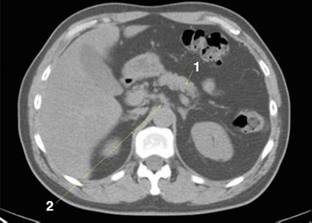 Phim chụp CT vùng bụng và xương chậu không thuốc cản quang cho thấy giải phẫu bình thường (lát cắt 9)