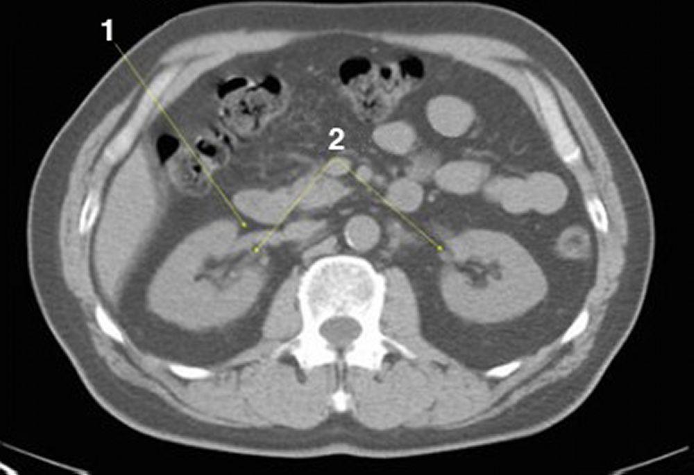 Phim chụp CT vùng bụng và xương chậu không thuốc cản quang cho thấy giải phẫu bình thường (lát cắt 14)