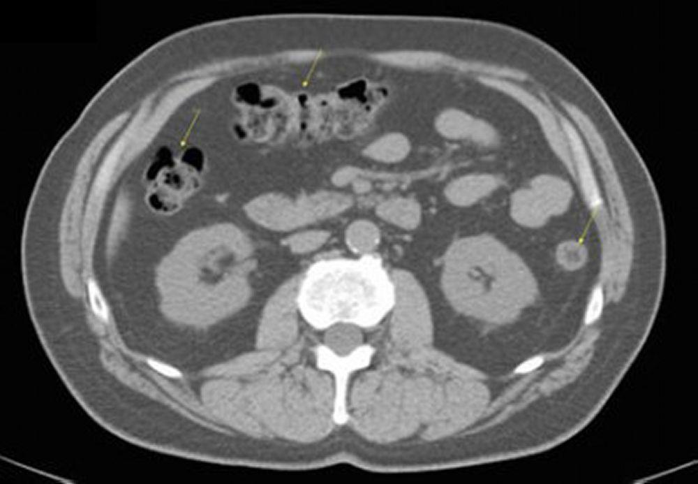 Phim chụp CT vùng bụng và xương chậu không thuốc cản quang cho thấy giải phẫu bình thường (lát cắt 19)