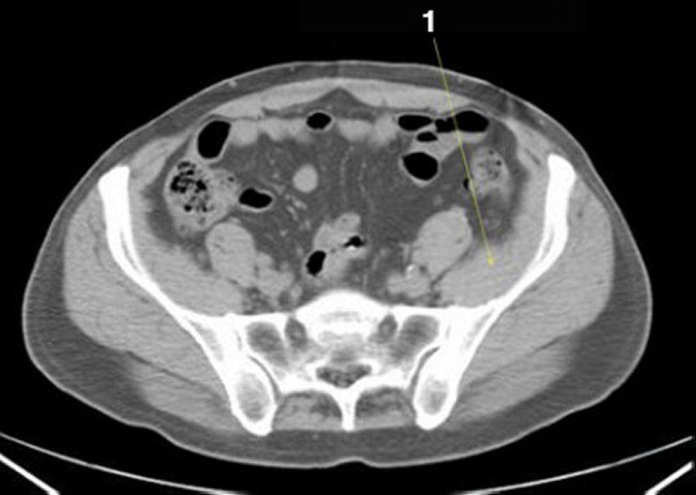 Phim chụp CT vùng bụng và xương chậu không thuốc cản quang cho thấy giải phẫu bình thường (lát cắt 22)