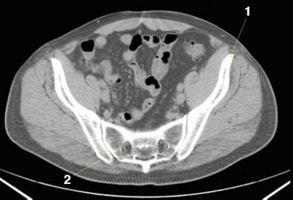 КТ брюшной полости и таза без контраста, демонстрирующая нормальную анатомию (слайд 23)