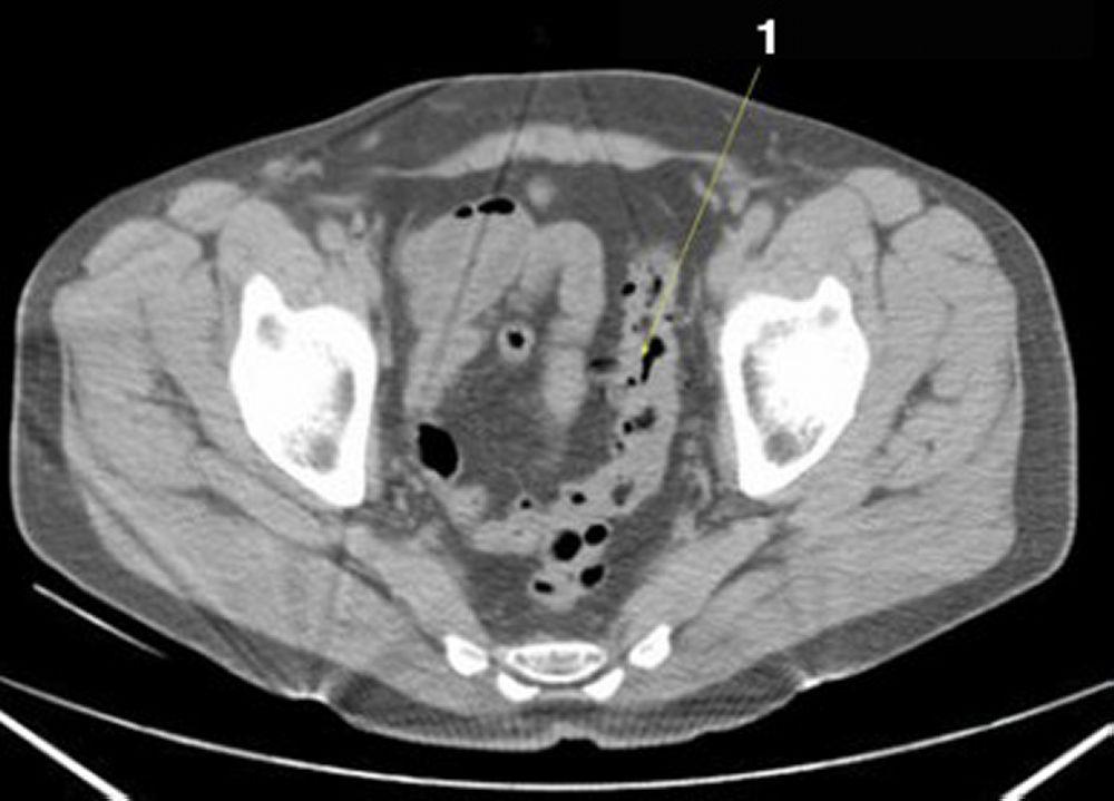 Phim chụp CT vùng bụng và xương chậu không thuốc cản quang cho thấy giải phẫu bình thường (lát cắt 25)