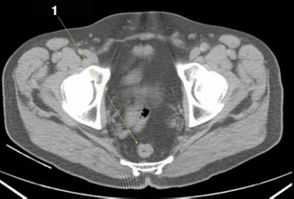 Phim chụp CT vùng bụng và xương chậu không thuốc cản quang cho thấy giải phẫu bình thường (lát cắt 27)
