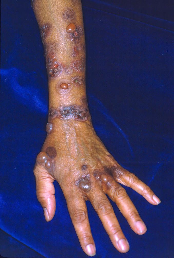 Pemphigoïde bulleuse sur le bras et la main