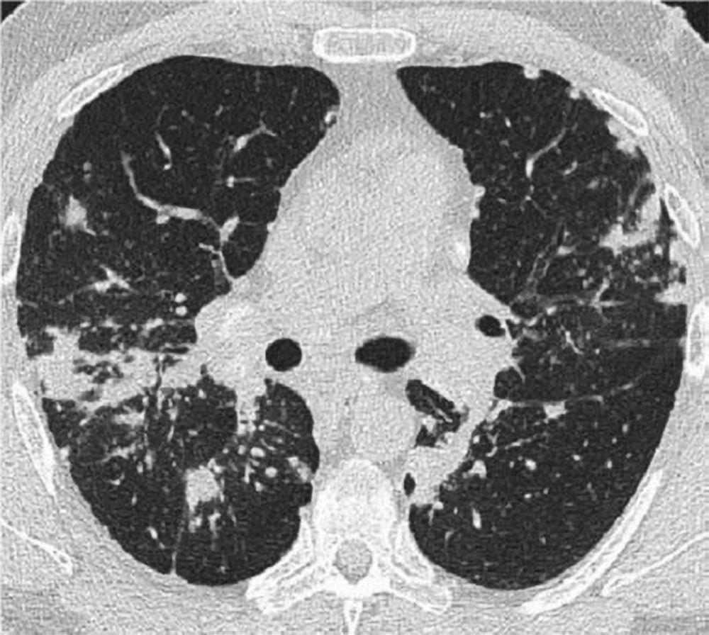 КТ органів грудної клітки при саркоїдозі легень